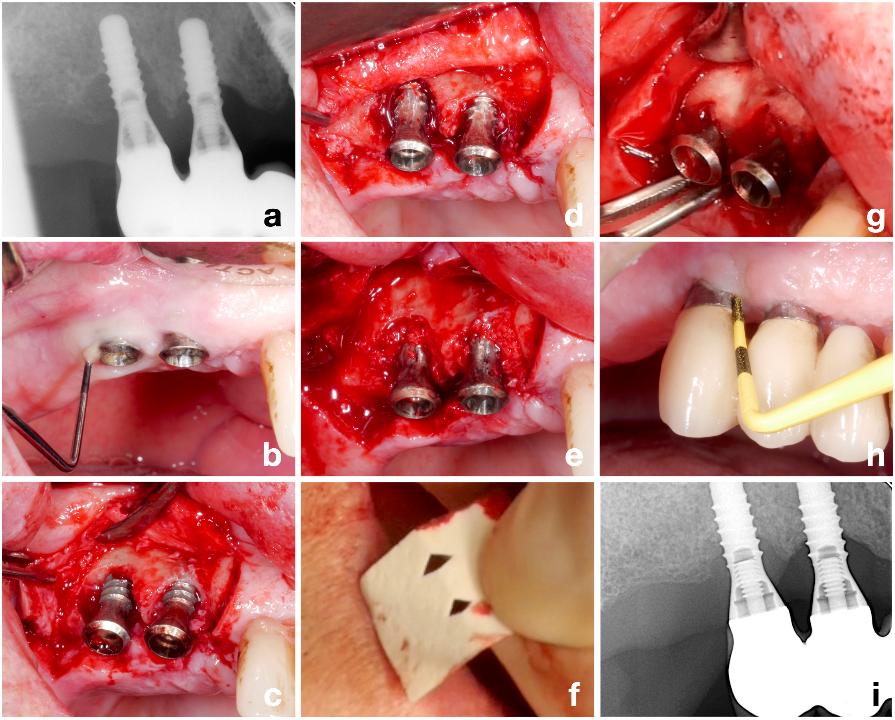Fig. 6: Patient case with peri-implantitis at the implants in position #14 and #15 (a - b) treated by a combined approach. After flap elevation a class Ic defect was recognized at both implants (c) and implantoplasty was performed at the buccal bone dehiscences (d). The vertical components were grafted with autologous bone (e) and the defects covered with a resorbable membrane (f - g). The procedure resulted in a stable post-operative result (h) with a significant improvement in the crestal peri-implant bone level especially at the implant in position #15 (i)