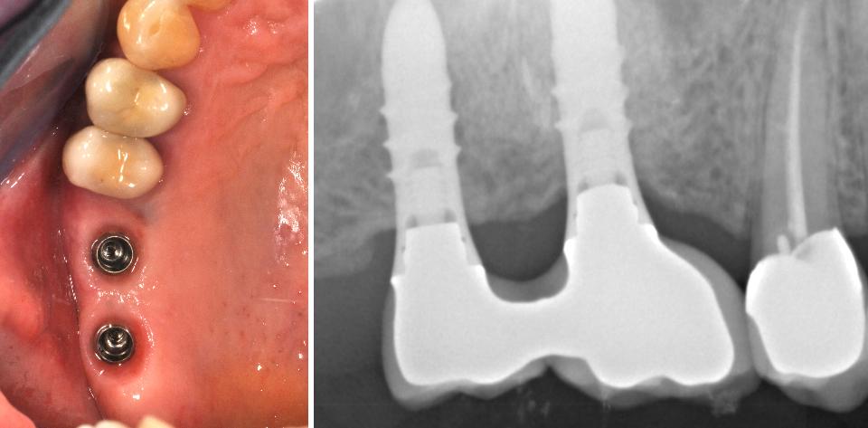 Şekil 5: Yükleme sonrası üçüncü ayda, implant kronları uzaklaştırılmıştır ve 16 nolu diş bölgesindeki implantın ISQ değeri 94 olarak ölçülmüştür. İmplant klinik olarak stabil görünmektedir, implant çevresi dokularda herhangi bir inflamasyon belirtisi görünmemektedir ve hastanın herhangi bir şikayeti yoktur. Periapikal radyograf üzerinde kemik yüksekliğinde ve yoğunluğunda herhangi bir farklılık gözlenmemektedir. 