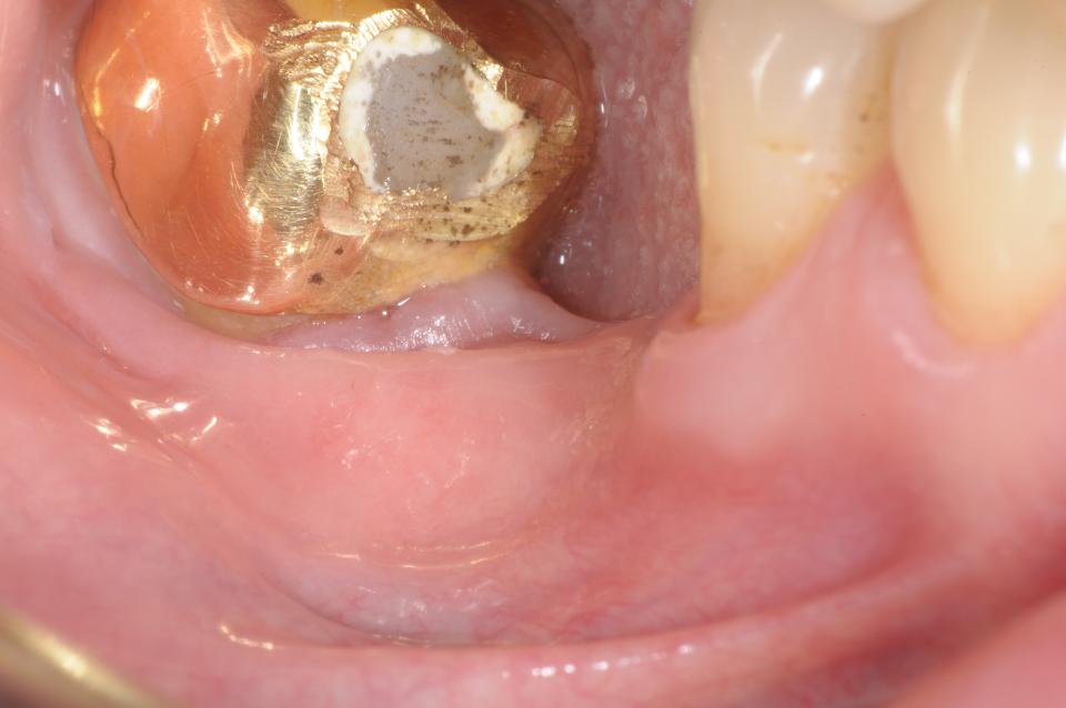 Fig. 3b: After removal of the prosthesis, the complete lack of attached mucosa associated with the presence of a frenum was evident in the edentulous area