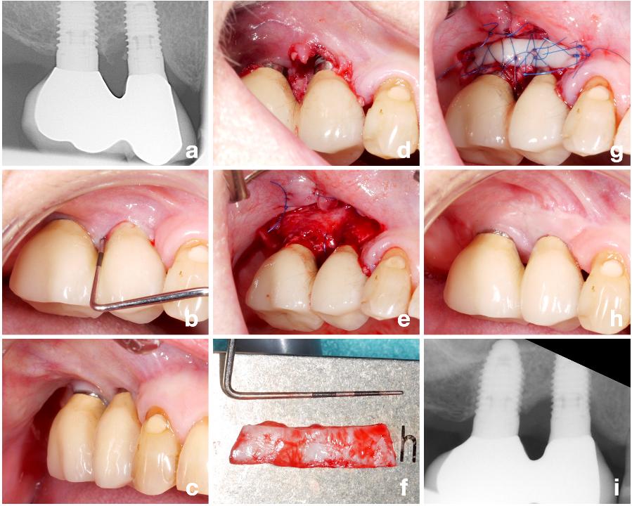 Fig. 8: Patient case with peri-implantitis at the implant in position #15 (most likely initiated by a cement remnant at the distal aspect) and peri-implant mucositis at the implant in position #16 (a - b) treated by a non-augmentative approach combined with a free gingival graft due to the lack of keratinized, attached peri-implant mucosa especially at the implant in position #15 (c). Minor flap elevation allowing access for surface decontamination (d) was combined with an apically positioned flap (e) and placement of a free gingival graft (f - g). The procedure resulted in a stable post-operative result with a significant increase in the width of keratinized, attached peri-implant mucosa (h - i)