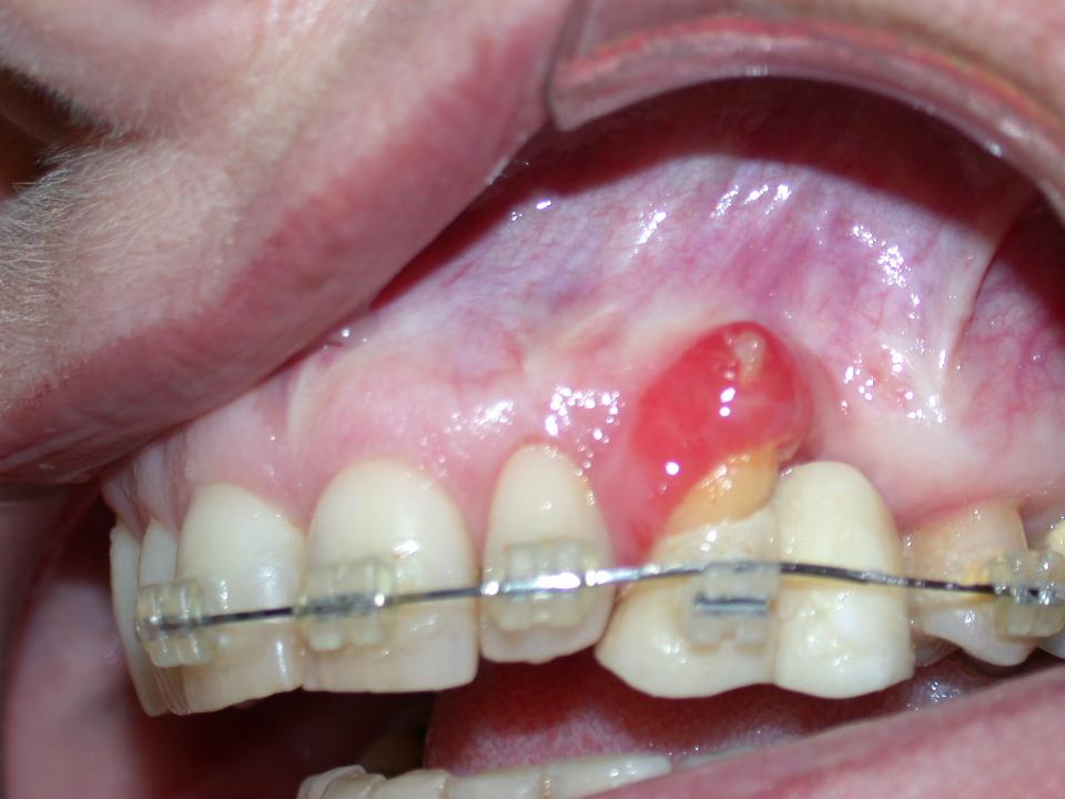 Fig. 7: Clinical photo showing result of eruption on the soft tissue, specifically sulcular eversion resulting in newly formed keratinizing tissue that is transforming into gingival augmentation in situ