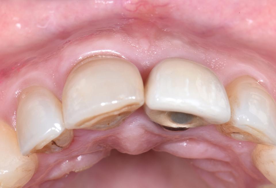 Fig. 5o: Occlusal view of the implant prosthesis after 3 years