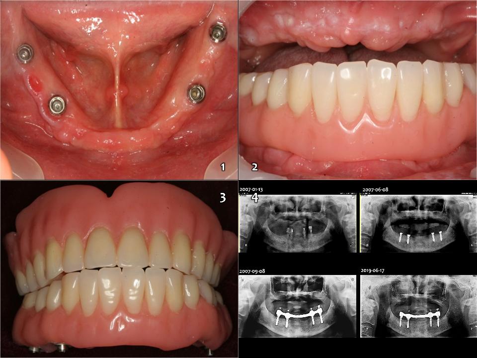 Fig. 11a: The 3rd priority option (Figs 6 - 7). Conventional complete denture on upper edentulous jaw and 4-implant (TL, 4.1x12, Ti, SLA, Straumann) on the lower edentulous jaw with a fixed hybrid prosthesis as all-on-4 concept (hard resin artificial teeth, 1-unit acrylic pink resin with Co-Cr reinforcement structure) which has worked very well over 12 years without any problems except for difficulty with hygiene care of the acrylic resin surface. In the periodic panoramic view (4), there was no crestal bone resorption on 4 implants in the mandible since 2007