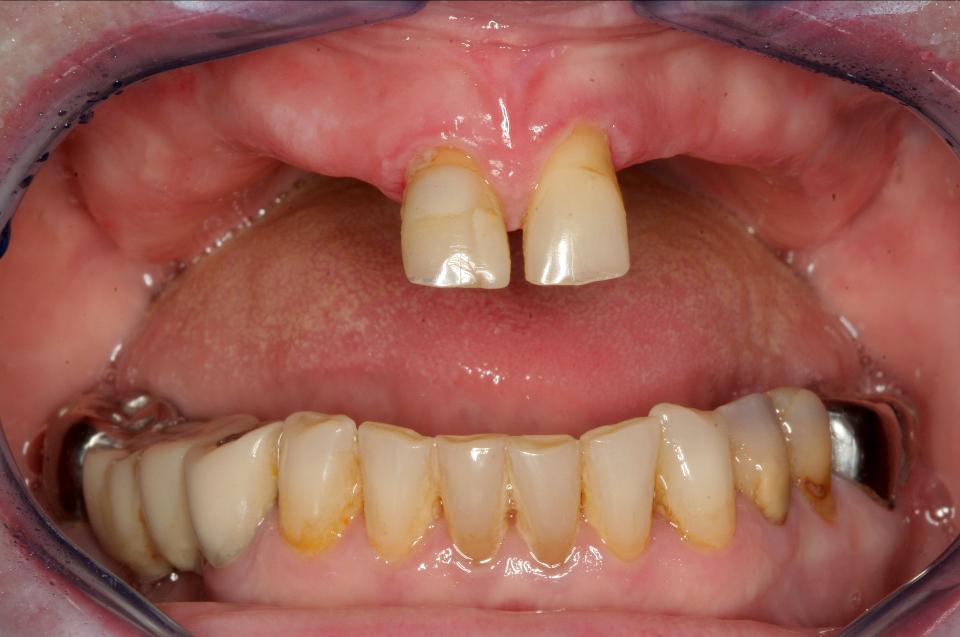 図6a: 62歳女性患者の既存の2本の上顎中切歯の初期口腔内画像。上顎に6～8本のインプラントで固定式補綴を用いる第1優先オプション （図5） が選択された。患者は上顎の暫間義歯を5年間使用しており、自然に見える固定式補綴を希望したためである。