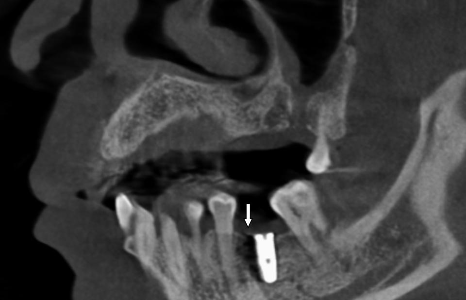 Fig. 10: Reconstruction sagittale de la mâchoire d’un patient porteur d’un implant dentaire dans la région molaires à partir d’images de tomographie à faisceau conique. La flèche blanche indique la zone où les artefacts gênent l’évaluation de la qualité de l’os péri-implantaire.