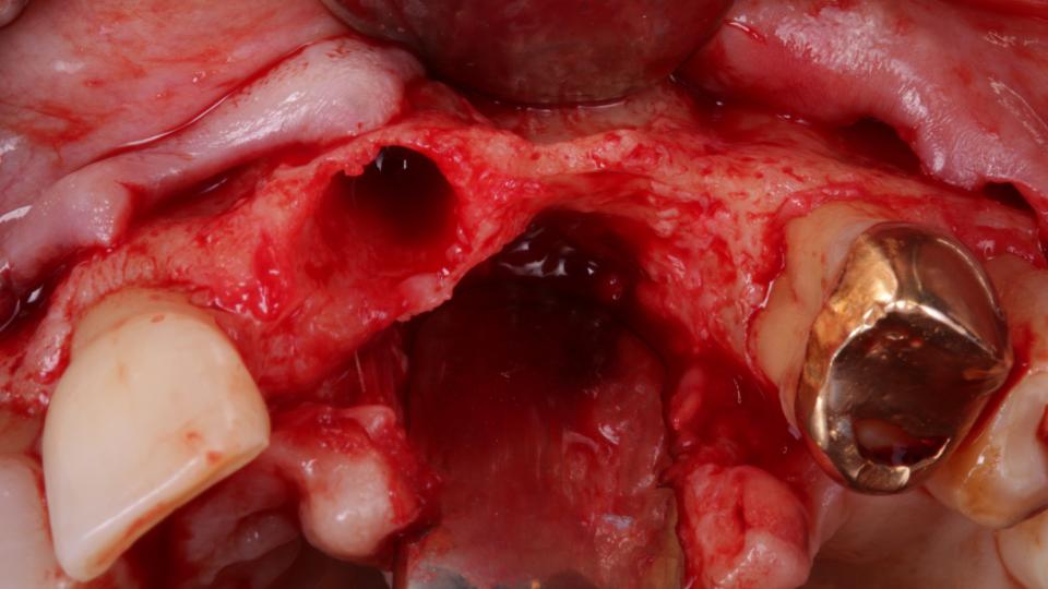 Abb. 12a: Horizontale und vertikale Knochentransplantation + Typ-4-Implantation: vertikaler und horizontaler Defekt.