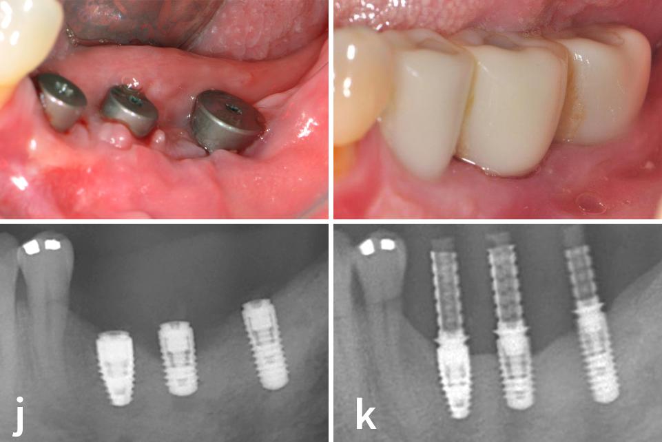 Fig. 4j - k: Confronto tra la fotografia intraorale e la radiografia prima dell'intervento (j) e quelle scattate 6 anni dopo l'intervento (k)