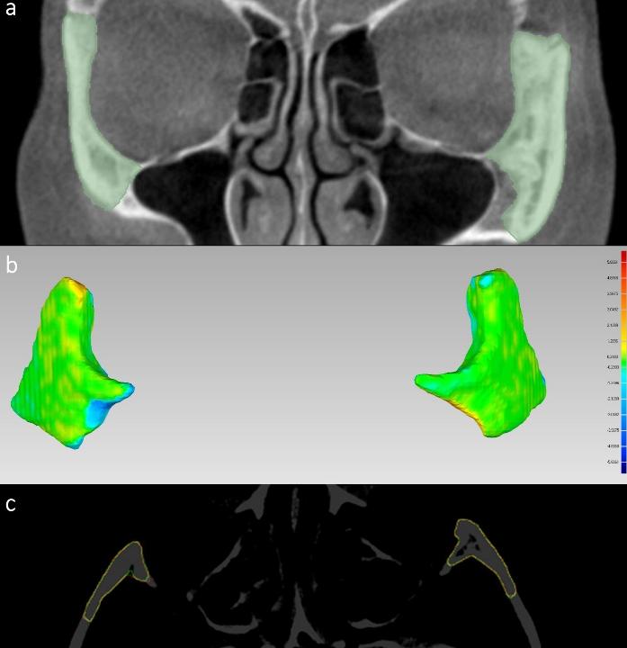 Fig. 5: Un esempio di segmentazione automatica basata sull'intelligenza artificiale delle ossa zigomatiche bilaterali di un paziente su immagini CBCT utilizzando il modello di apprendimento profondo di Tao et al. (Tao, Yu, et al. 2023). La parte superiore (aree verdi in a) mostra le ossa zigomatiche segmentate automaticamente. La parte centrale (b) mostra gli errori di distanza superficiale tra le segmentazioni automatiche e manuali (previsione vs. verità a terra). La parte inferiore mostra la sovrapposizione dei bordi della previsione e della verità a terra