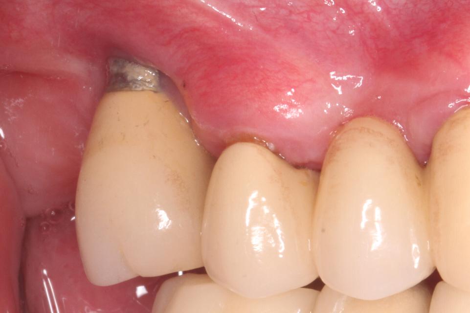 Fig. 3a: All'impianto del sito 1.6 è stata diagnosticata una perimplantite. Sono stati rilevati 6 mm di profondità di sondaggio (PD) sulla superficie buccale e 8 mm di PD sulla superficie palatale dell'impianto. È stata inoltre riscontrata una mancanza di mucosa buccale cheratinizzata