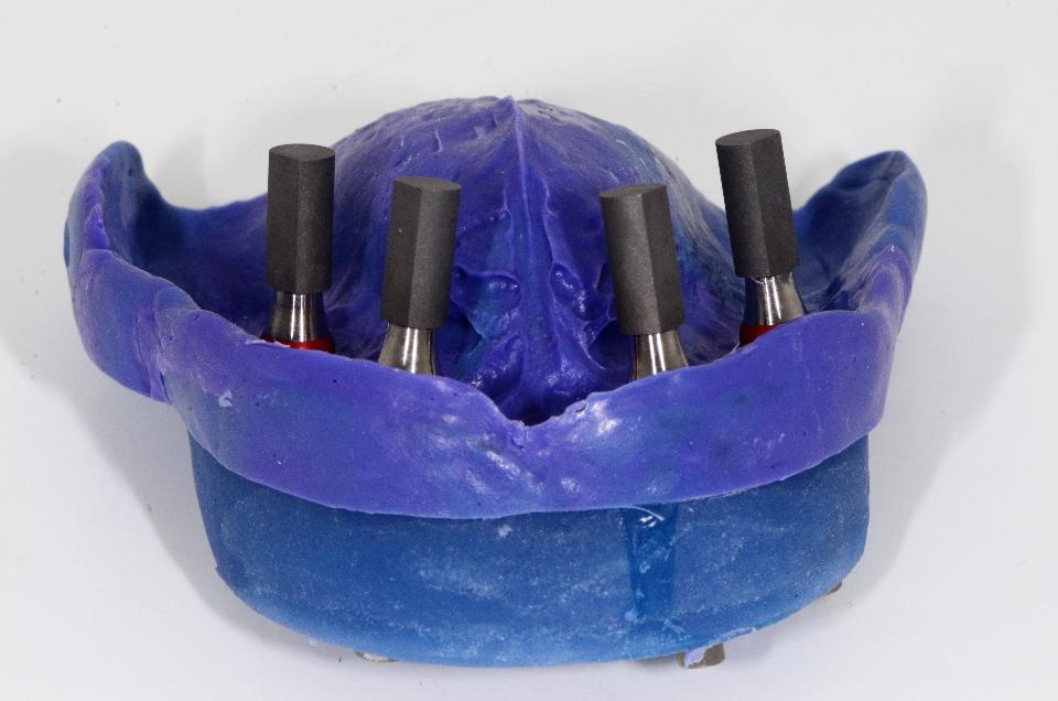 Fig 19a: The AvaDent system allows a complete denture to be transformed into a fixed supraconstruction by means of digital duplication techniques