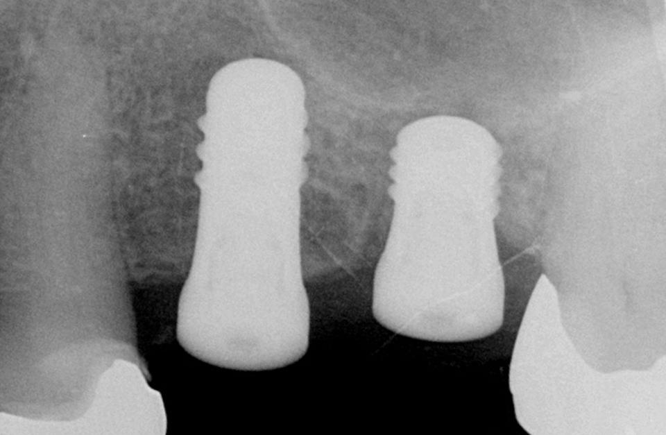 Fig. 5a: In this 76-year-old female patient with multiple medical risk factors, a SFE was contra-indicated. An ultra-short, 4-mm implant has been used to bypass a SFE procedure. The post-operative radiograph shows a 4-mm TL implant placed with an 8-mm TL implant