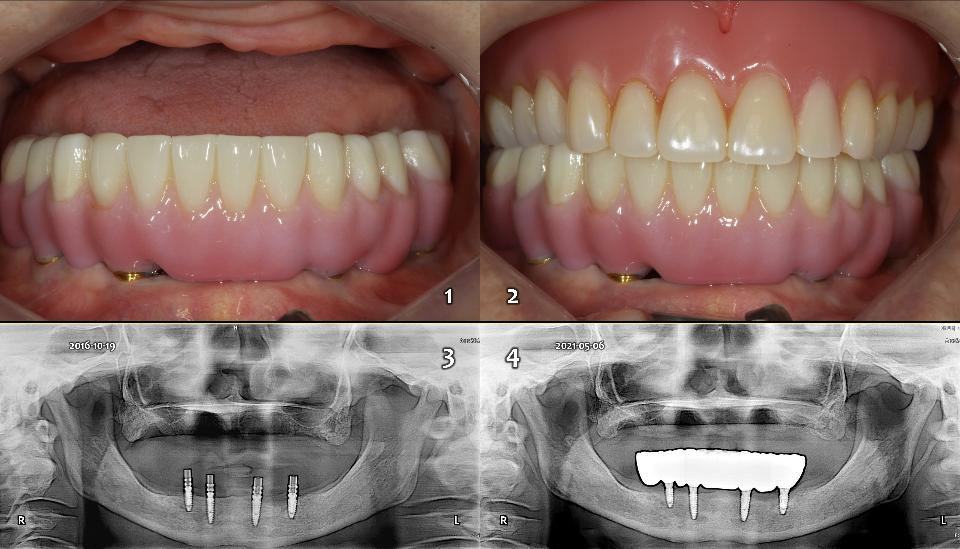 Fig. 12a: The 3rd priority option (Fig. 6-7). Conventional complete denture (CD) on upper edentulous jaw and 4-implant (IS-II, 4.5x10, 4.5x8.5, 4.0x10, 4.0x8.5, Ti, Neobioteck, Korea) on the lower edentulous jaw with the fixed hybrid prosthesis which was fabricated as 1-unit monolithic zirconia with pink porcelain (1-2) (Prettau, Zirkonzahn, Gais). The prostheses have been working very well for 5 years since 2016 without any hygiene problem. In the periodic panoramic view (3 - 4), there was no crestal bone resorption on the 4 implants in mandible to date