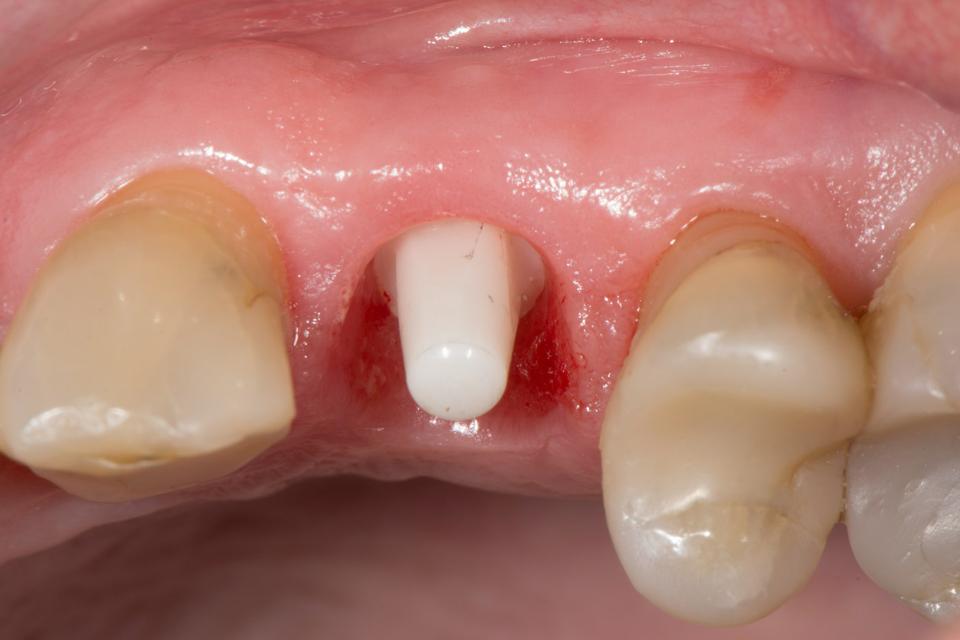 Fig. 4c: Peri-implant soft tissue conditions 3 months after implant placement (Photo credit: Stefan Roehling)
