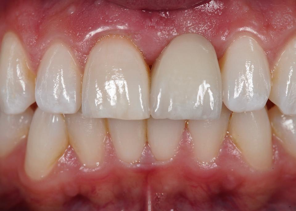 Fig. 18: Inadequate soft tissue volume at the left central incisor implant site has resulted in an asymmetric esthetic outcome when examining the gingival margins