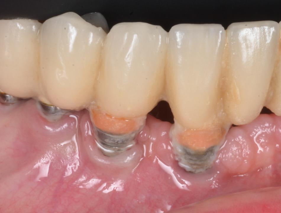 Fig. 6a: Implants placed without regard to the buccal bone thickness are very frequently more prone to developing excessive physiological buccal bone loss. This in turn may condition the peri-implant tissue stability in the long-term. These cases are often associated with the lack of keratinized mucosa in the buccal aspect