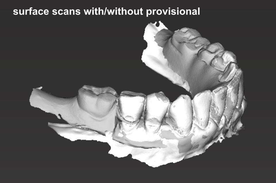 Fig. 5: Two intraoral scans matched in a common coordinate system: The anatomical situation (white) and a removable interim prosthesis (gray) are shown