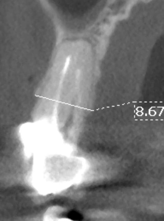 Fig. 2d: The oro-facial CBCT at tooth #14 shows sufficient crest width of >6 mm for a future implant placement