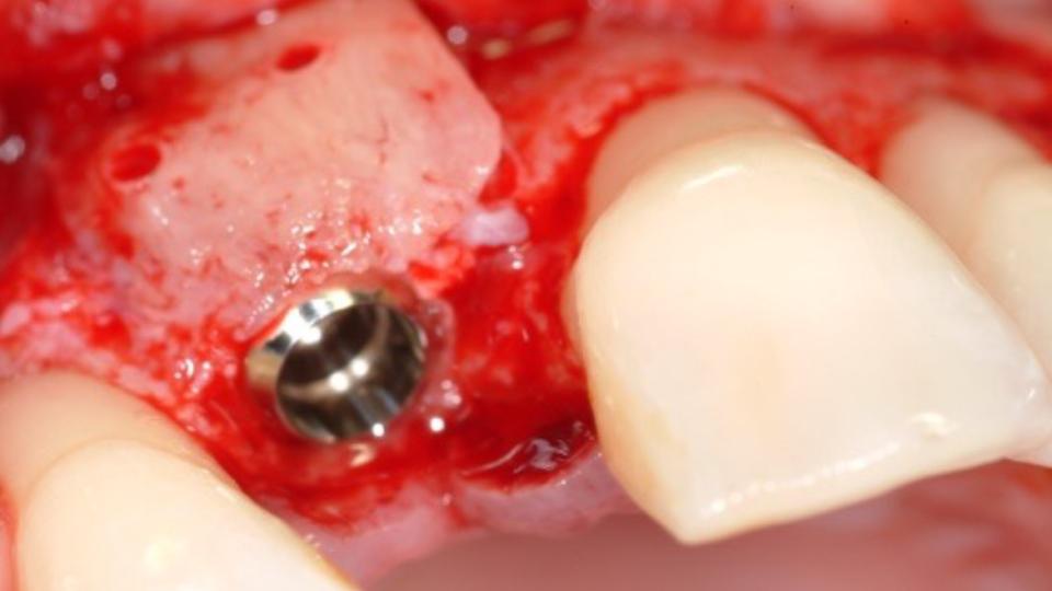 Fig. 11c: Injerto en bloque + Colocación de implante tipo 4: Preparación óptima del lecho del implante que permite un hueso vestibular grueso