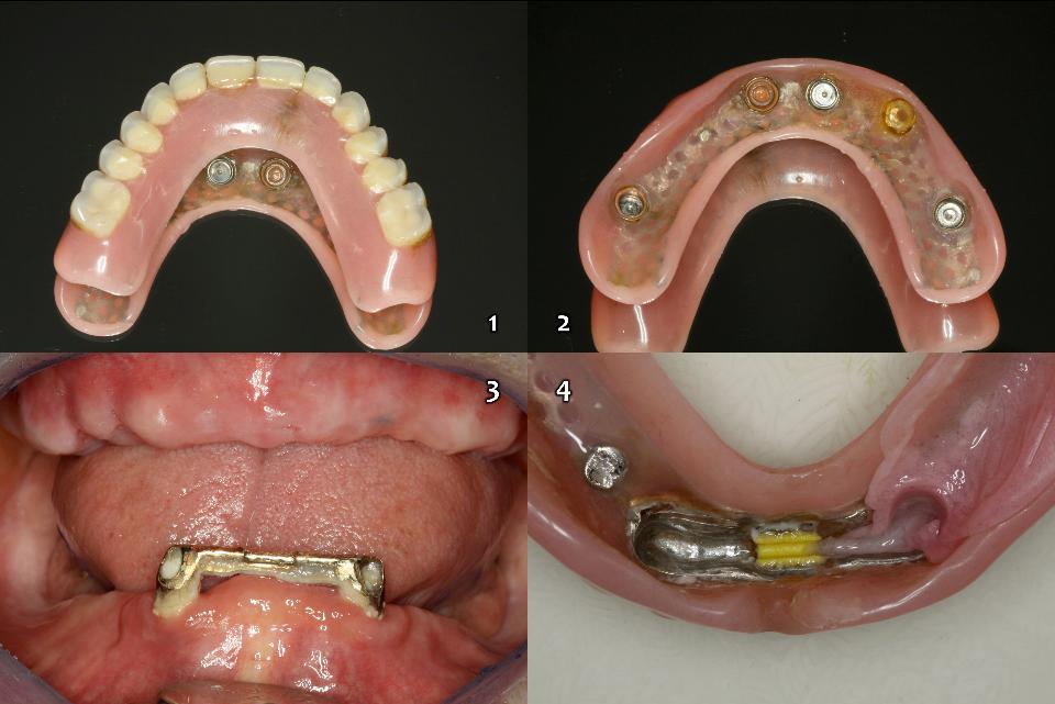 Fig. 16c: Considering the degree of disability and age of the patients, prosthodontic option and retentive devices for the IOVD should be selected that elderly disabled patients can handle and manage hygiene well. (1-2: 5 implants with malfunctioning locators; and 3 – 4: mishandling with hygiene failure on the bar-clip device IOVD)