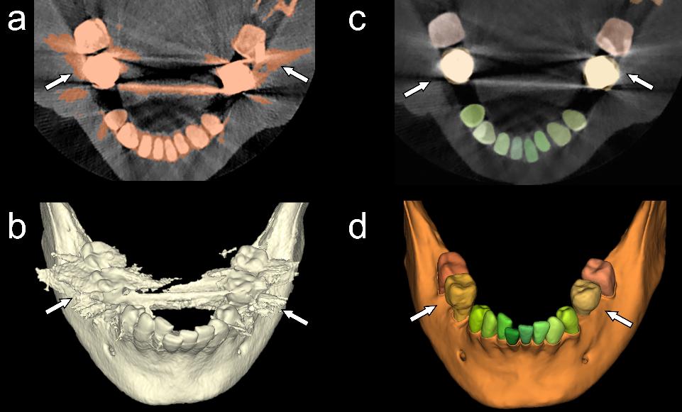 Fig. 14: Reconstructions axiales en tomographie à faisceau conique (a et c) et rendus volumétriques D3 correspondants (b et d) générés par segmentation par seuillage dans deux applications logicielles de segmentation différentes. Les flèches blanches indiquent les zones où l’exactitude de la segmentation diffère significativement entre les deux applications. Avec l’aimable autorisation du Dr Bahaaeldeen M. Elgarba et de la Pre Reinhilde Jacobs.