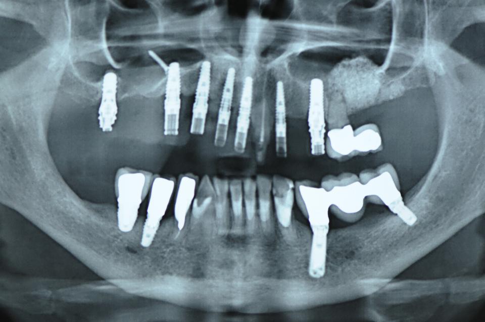 Fig. 5f: Panoramic view with implants and provisional restoration