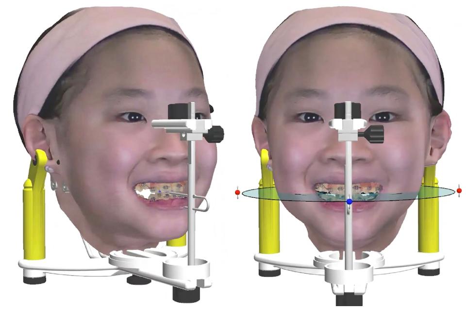 Fig. 17: Using the facial anatomic landmarks, a virtual articulator may be used to simulate/estimate the patient’s dynamic occlusal contacts