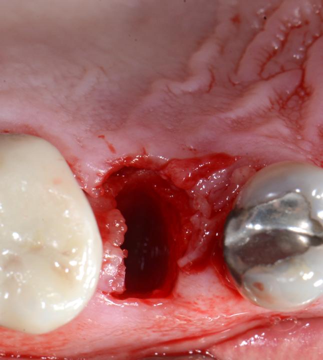 Fig. 6c: To facilitate extraction of the tooth, a palatal flap was raised and the tooth carefully extracted. The bone walls were intact