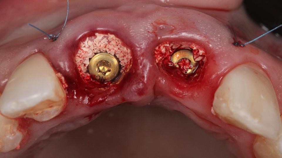 Abb. 6f: Typ-1a-Protokoll – in die Spalte wurde ein Knochenersatzmaterial (Xenograft) transplantiert, um bessere klinische Ergebnisse zu erzielen. Gut zu erkennen ist das zusätzliche Weichgewebetransplantat auf der Bukkalseite