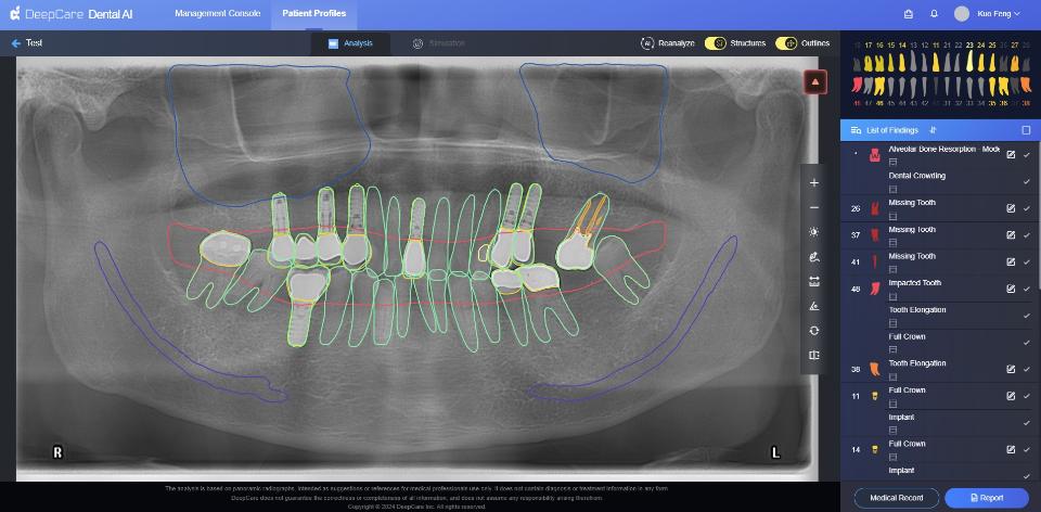 Fig. 3: An example of fully automated identification of teeth (green contours), crowns/bridge/implant (yellow contours), mandibular canals (purple contours), endodontically-treated canals (orange contours), and maxillary sinuses (blue contours) on a single panoramic image using DeepCare Dental AI (DeepCare, Los Angeles, USA)