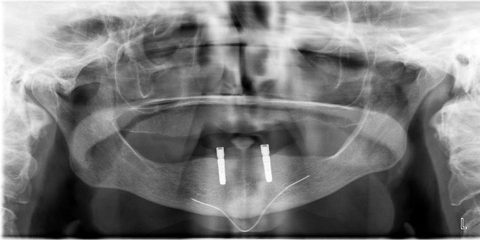 Fig. 3: Radiografia panoramica con due impianti mandibolari. I livelli ossei della cresta edentula negli studi inclusi nella terza revisione sistematica sono stati valutati su radiografie panoramiche