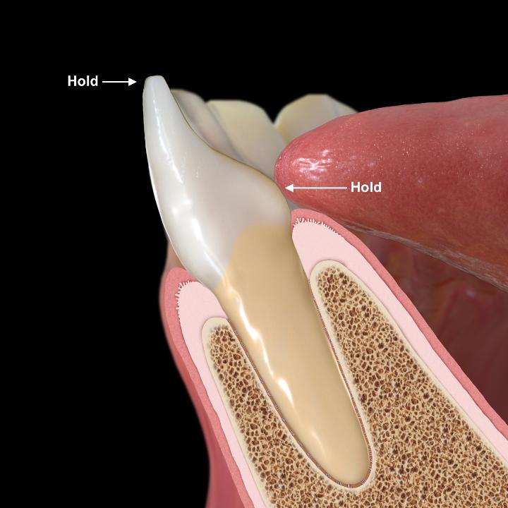 図4: アライナーメカニズムの力のかけ方。アライナーが歯冠全体にぴったりとフィットしているのが特徴。デジタルインプレッション、高解像度3Dプリント、正確な熱成形などの機能により、歯冠の特定部位に力を加えることができ、より高度な動きを容易にする