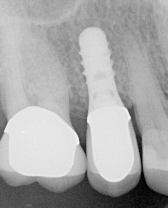 Fig. 4h: Control radiograph taken 6 years after immediate implant placement and early loading (type 1B protocol)