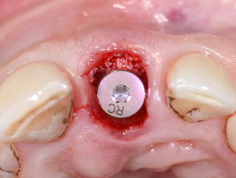 Fig. 5h: An RC healing abutment was attached to the implant. The facial defect was then grafted with a DBBM bone substitute (BioOss; Geistlich Pharma, Wolhusen, Switzerland) to the level of the facial bone crest