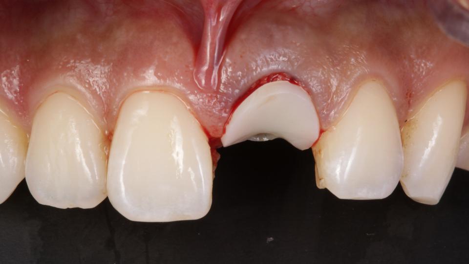 图. 8c: 1型种植: 牙槽窝封闭技术（Socket sealing technique，SSA)