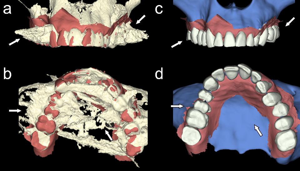 Fig. 13: Alignement de la numérisation intraorale et du rendu volumétrique 3D en tomographie à faisceau conique en vue frontale (a et c) et vue inférieure (b et d) par deux applications logicielles de segmentation différentes. Les flèches blanches indiquent les zones où l’exactitude de la segmentation diffère significativement entre les deux applications. Avec l’aimable autorisation du Dr Bahaaeldeen M. Elgarba et de la Pre Reinhilde Jacobs.