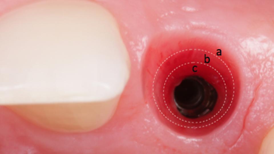 Resim. 14: Lateral kesici konumundaki geçici implant restorasyonuyla gerçekleştirilen yumuşak doku şekillendirmesi, anatomik olarak doğru bir çıkış proflini hazırlıyor. Çıkış profilinin yönetimi üç bölgeye ayrılır: insizal bölge (a), geçiş bölgesi (b), servikal bölge (c)