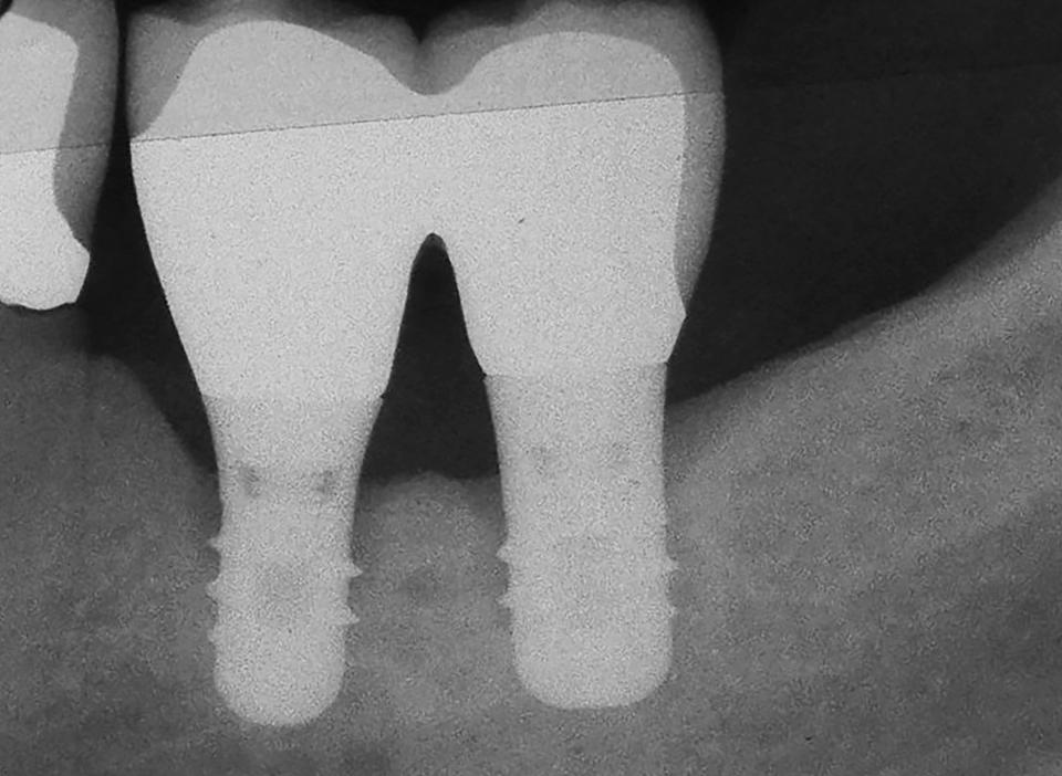Fig. 4b: 10-year follow-up. First signs of bone loss in the crestal area at implant 36, but no signs of local infection