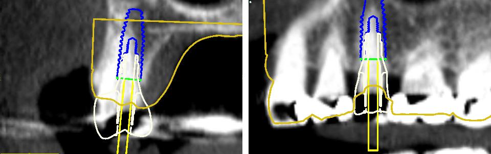 Fig. 3p: Assessment of CAD implant restoration contours relative to the bone anatomy visible in the CBCT