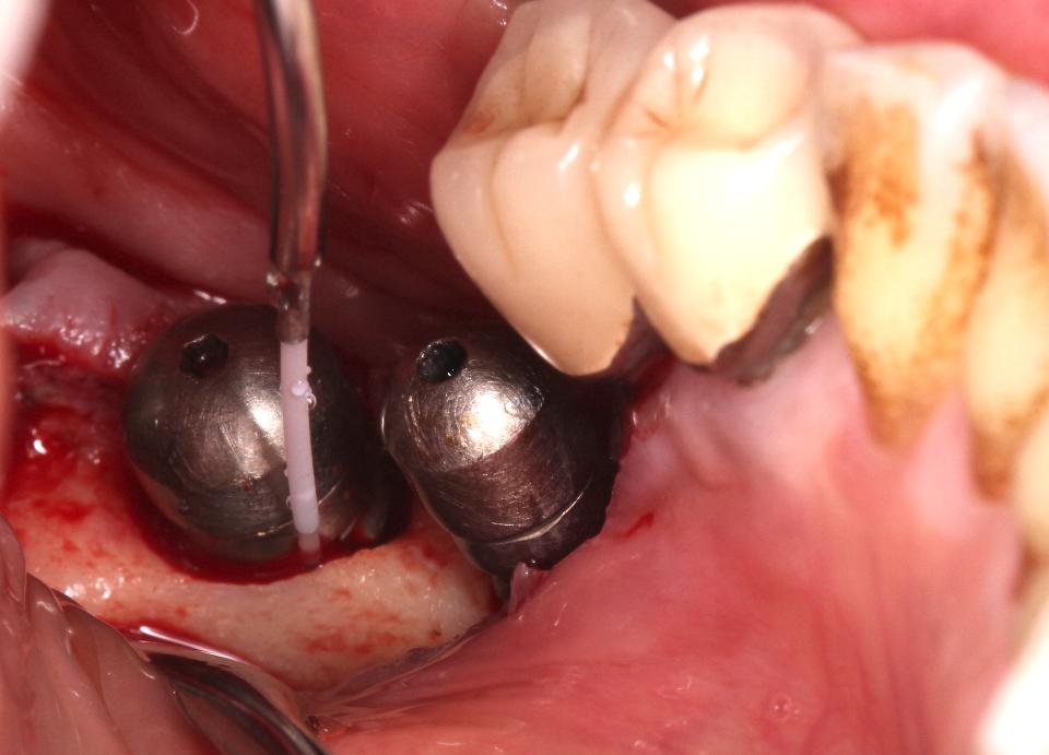 Fig. 2e: Le laser Er:YAG a été utilisé pour l'élimination des tissus granulomateux et la décontamination de la surface de l'implant. (AdvErL EVO, J. Morita, 2940nm, 25 pps, 50 mJ, rapport eau/air de 7/10).