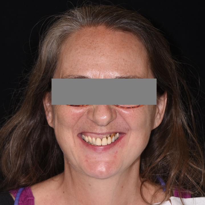 Fig. 5a: Sonrisa gingival extraoral antes del tratamiento