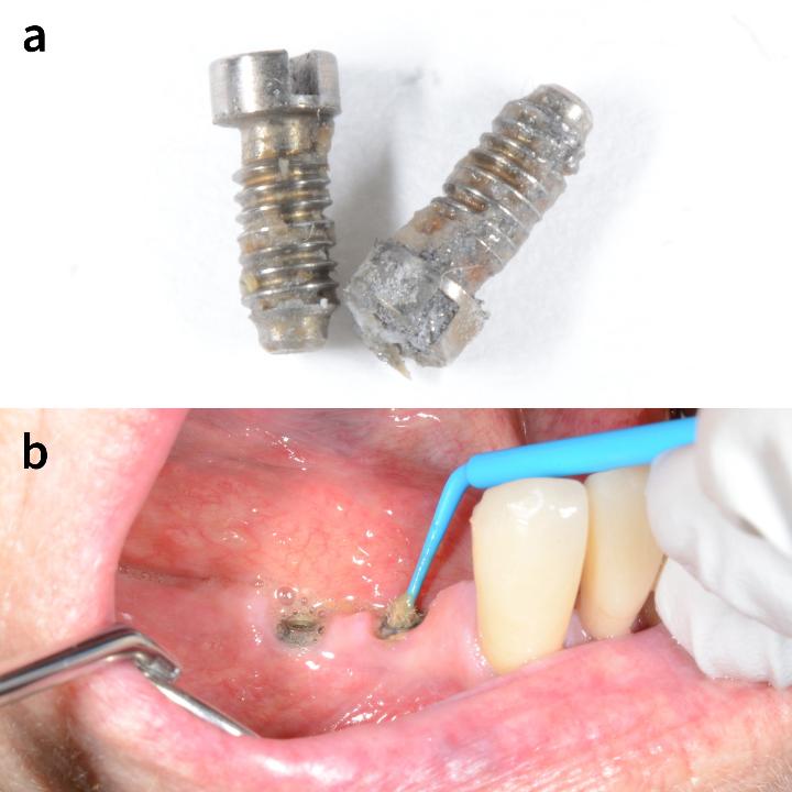 Fig 8: Screws one week after prosthesis felt “loose”. Notice the migration of plaque along the length of the screws (a) and consequent need for careful cleaning with hydrogen peroxide prior to replacement of the prosthesis (b)