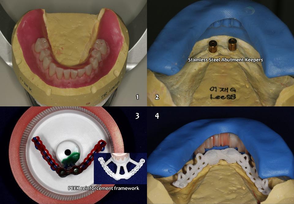 図15b: 下顎の2本インプラントの磁性オーバーデンチャーの技工所手順。1：下顎ワックス義歯。 2：ワックス義歯の外見をラバーパテで複製して型を形成した。 3：アクリルレジンの義歯床の破損を防ぐため、PEEK材料 （Bio HPP、Bredent group （ドイツ） を強化フレームワークとして使用した。PEEK （Bio HPP） はポリエーテルエーテルケトン （技術用・工業用の高性能ポリマー） であり、口腔内用の材料である。4：PEEKフレームワークとレジン歯をラバーパテ型と石膏模型の間の空間に配置し、ピンクアクリルレジン注入のスペースをチェックした