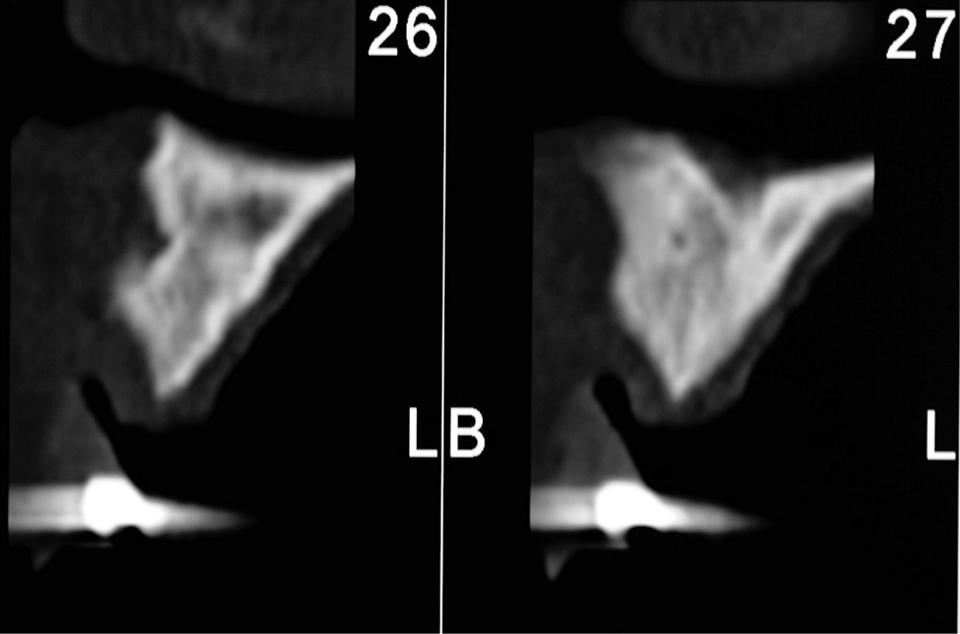 Fig. 4c: Preoperatory CBCT crosscut