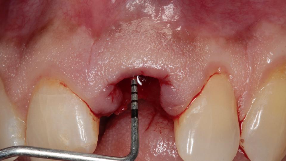 Abb. 3c: Minimalinvasives Verfahren zur lappenlosen Zahnextraktion – Ansicht von frontal nach der Extraktion. Bei der Inspektion der Alveolenwände fällt ein deutlicher Knochendefekt auf, der eine Kontraindikation für die Fortsetzung des Typ-1a-Protokolls sein kann