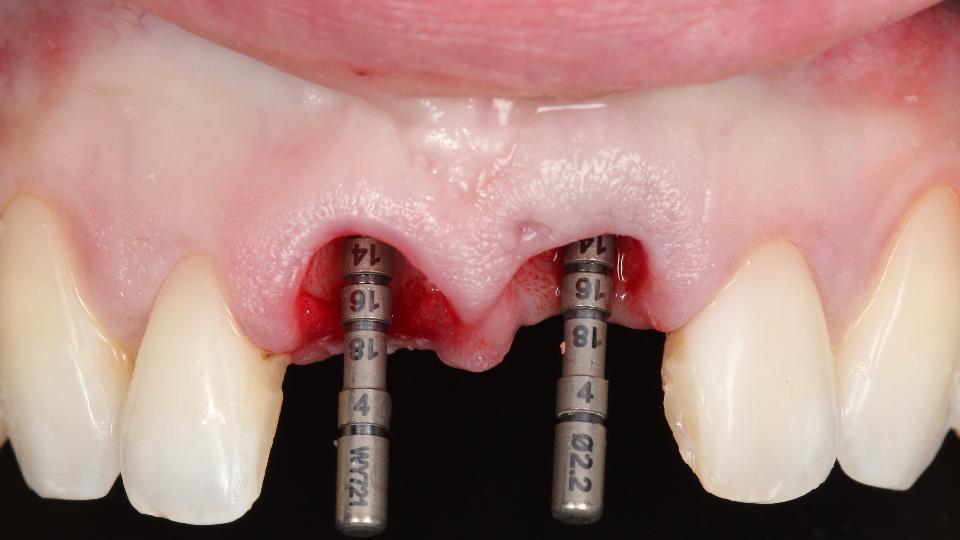 Fig. 5c: Uso del protocollo di chirurgia implantare statico-computerizzata completamente guidata per l'inserimento immediato dell'impianto – uso del calibro di profondità (ø2,2 mm) per confermare la posizione dell'osteotomia