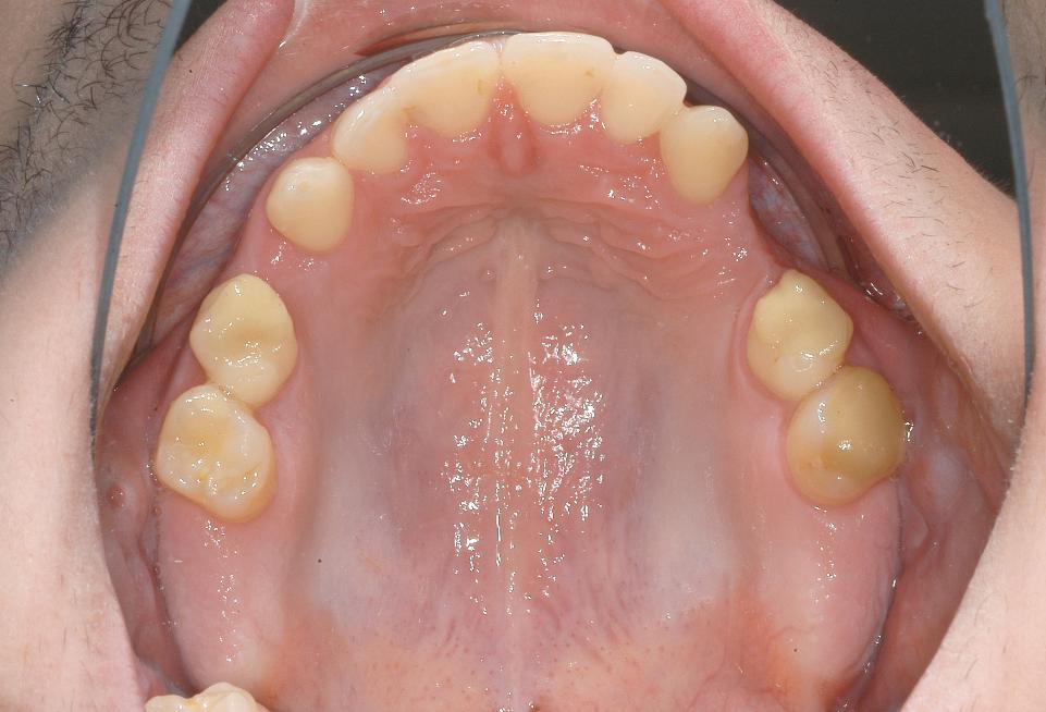 图2b: 19岁男性患者，外胚层发育不良，多颗牙齿缺失，初诊时的临床状况：上颌合面照
