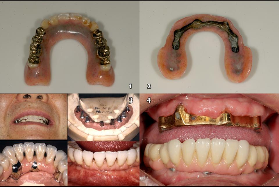 Fig. 8a: 4-implant bar-joint structure and magnetic overdenture (1 - 2) on upper edentulous jaw as the 2nd priority option (Fig. 5), and 4 - 6 implants on the lower edentulous jaw with fixed 3-segmented prosthesis (3 - 4)