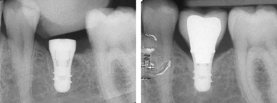Fig. 3a: Radiographic situation of a short implant (6 mm) at the time of placement and 1 year after loading