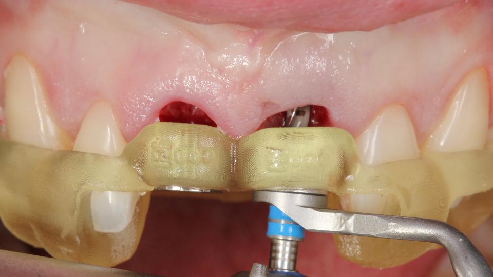 Fig. 5b: Utilización del protocolo totalmente guiado de cirugía de implantes asistida por ordenador estático para la colocación inmediata de implantes – región #21 – fresa piloto (ø2,2 mm) durante la preparación de la osteotomía