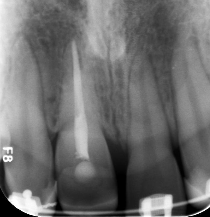 Resim 7b: Sandviç osteotomi tekniği. Periapikal radyografi bize, endodontik olarak tedavi edilmiş 11 numaralı diş kökünün kemik ile yer değiştirdiğini gösteriyor. Komşu diş köklerine herhangi bir yakınlık göstermediği izleniyor. 
